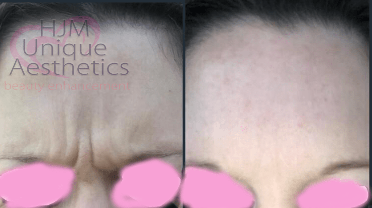 Home Botox Anti Wrinkle Injections, Dermal Filler Clinic Ramsgate